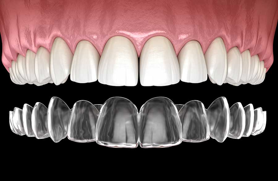 Invisalign braces Cucalon & Matin Orthodontics in San Francisco, CA