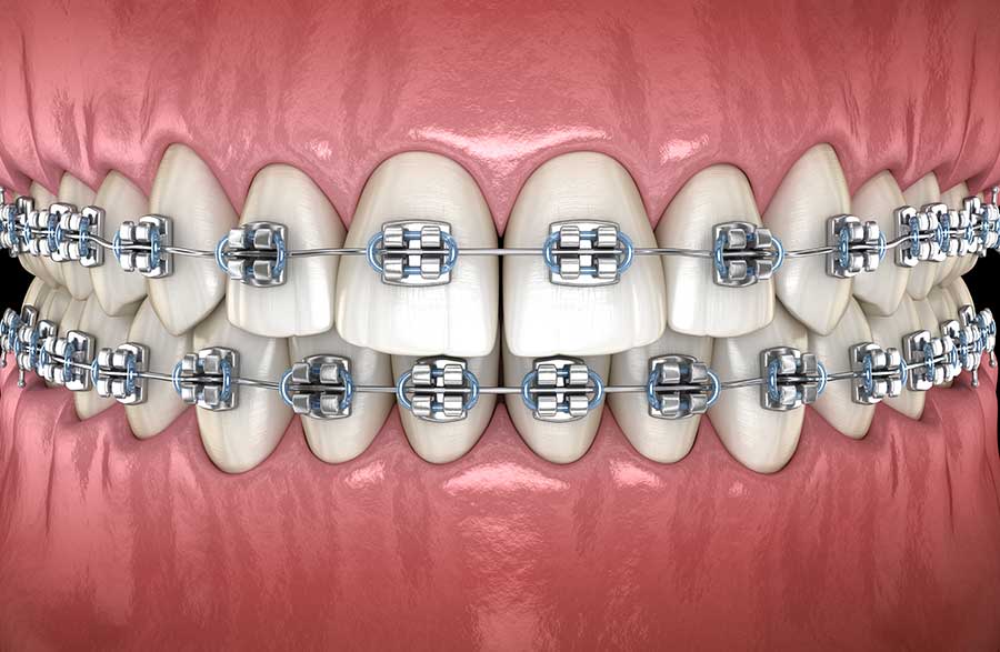 Types of Braces, Kashner Orthodontics