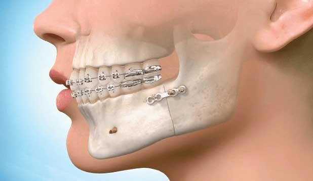 Surgical Orthodontics  Cucalon and Matin Orthodontics