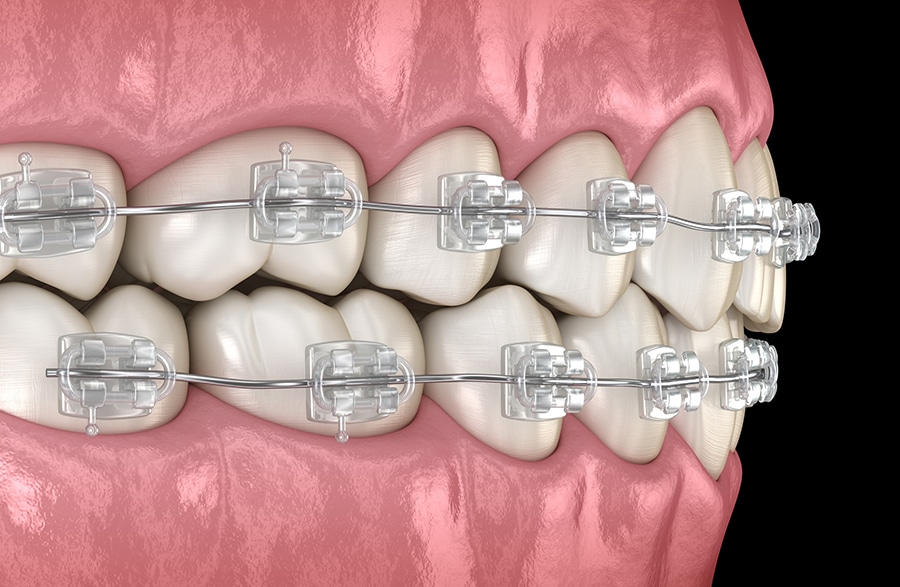 Types of Braces - Orthodontist San Clemente San Juan Capistrano CA